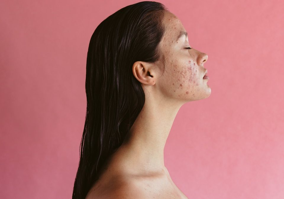 woman with acne in a pink background