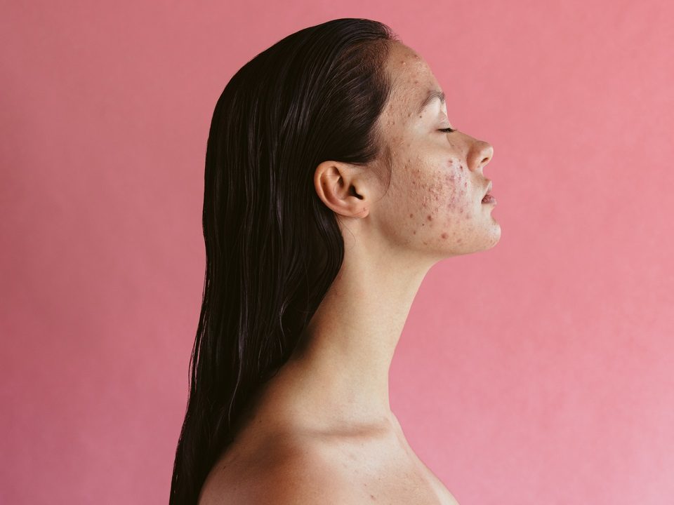 woman with acne in a pink background