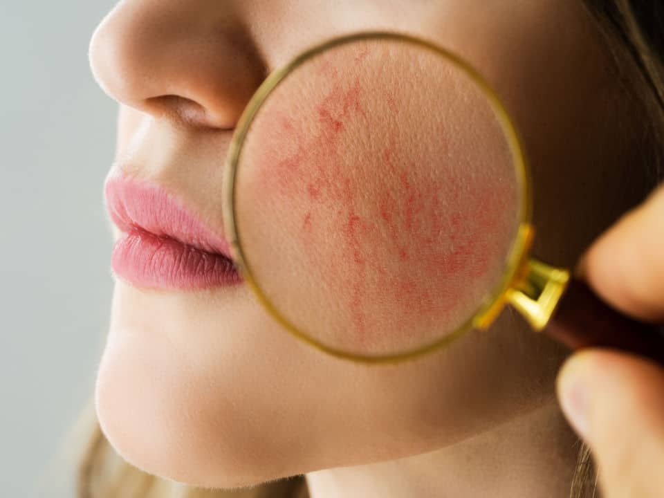 doctor checking up patients type of rosacea